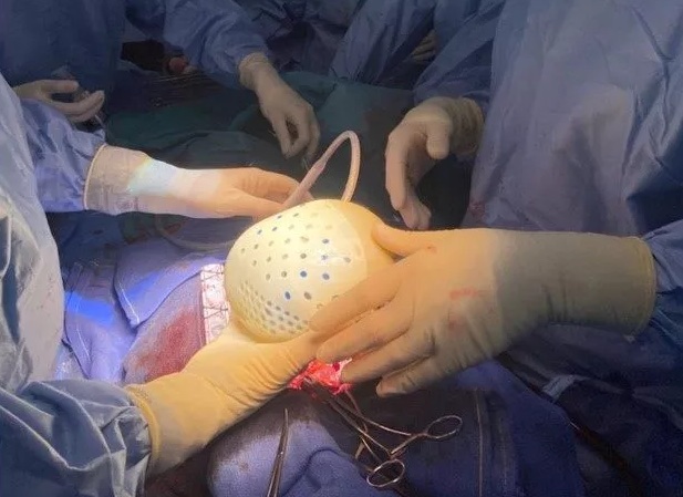 L’avenir du cœur artificiel total menacé par la faillite de Carmat
