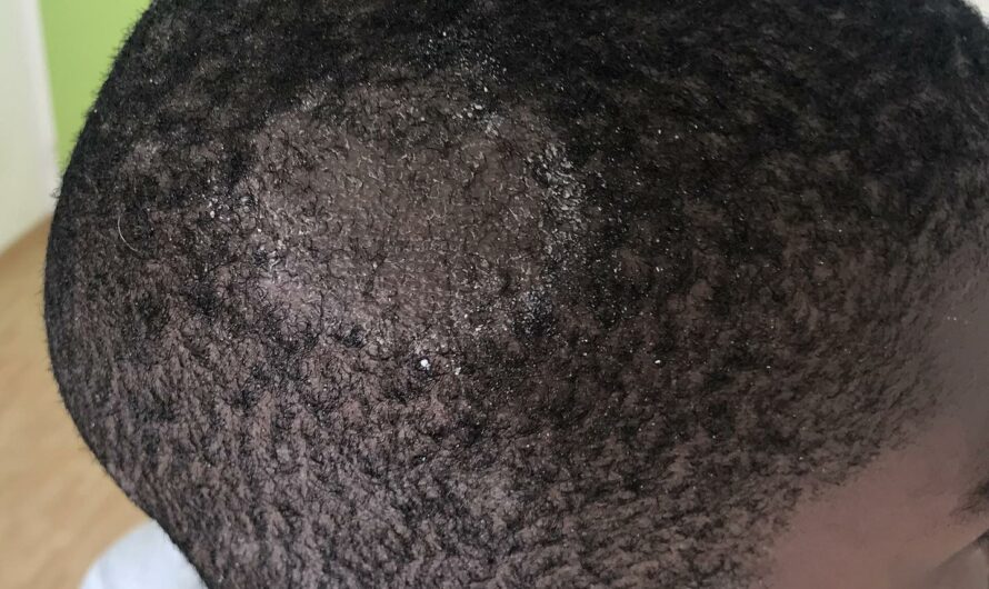 Casques Partagés en Taxi-Moto : Quels Risques Sanitaires pour la Peau et le Cuir Chevelu ?